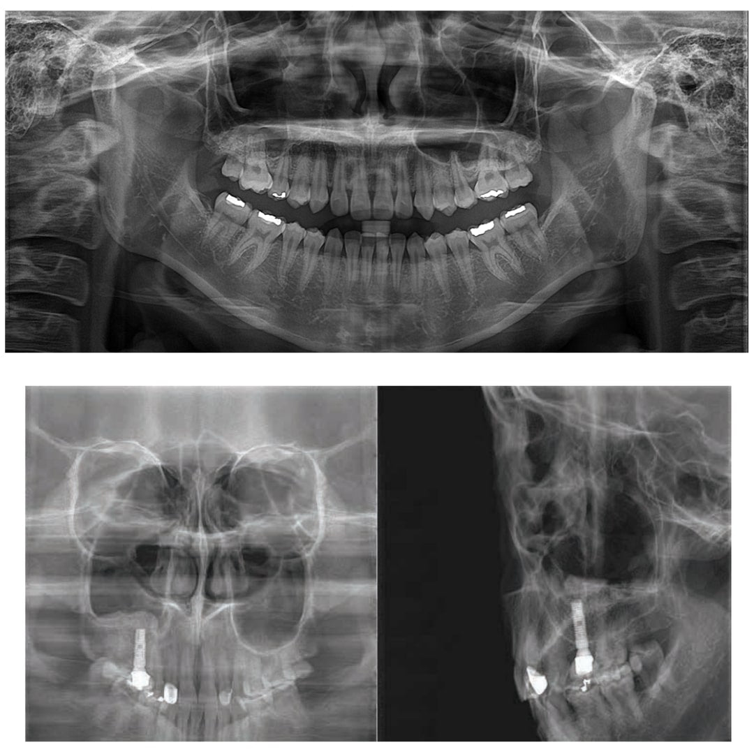 Aparat radiologie 2D/PANO Genoray Papaya