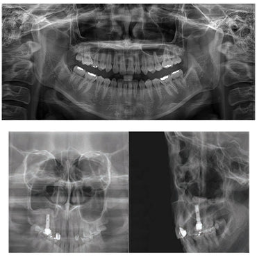 Aparat radiologie 2D/PANO Genoray Papaya